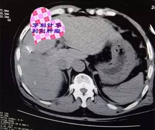 【永医前沿】外三科顺利完成“CT定位下肝肿瘤射频消融手术”！