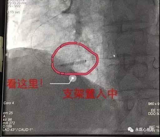 永清县人民医院内二科介入治疗中心