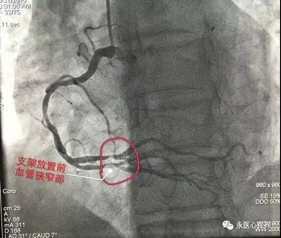 永清县人民医院内二科介入治疗中心